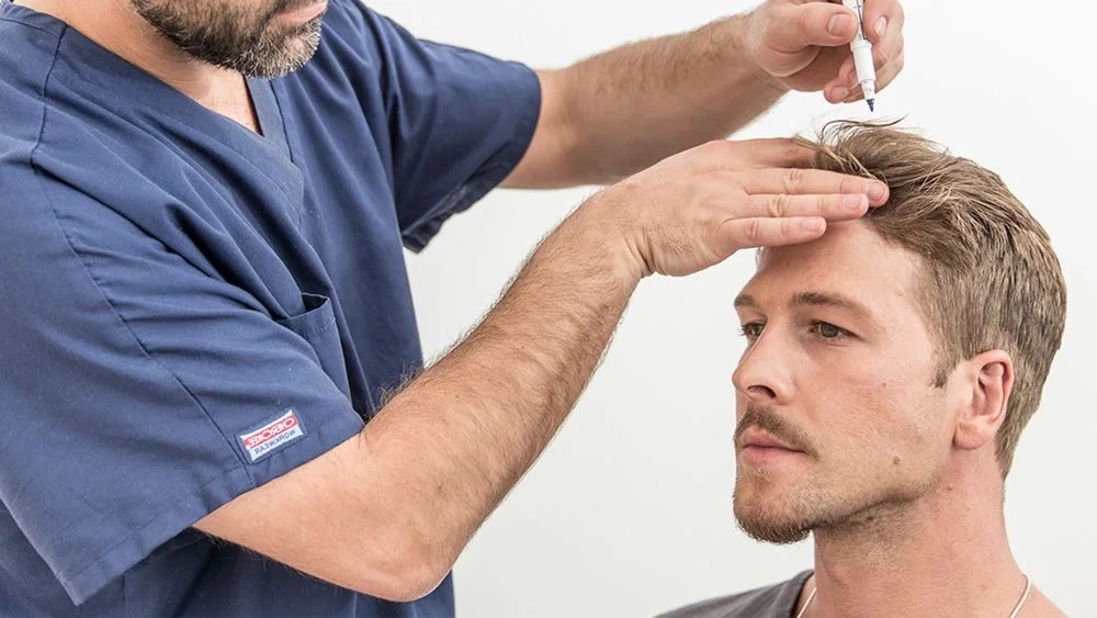 تكلفة زراعة الشعر