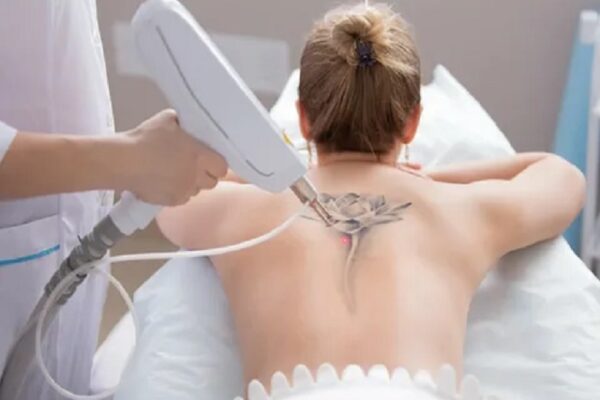 Laser Tattoo Removal in Riyadh