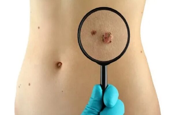 Birthmark Removal in Riyadh