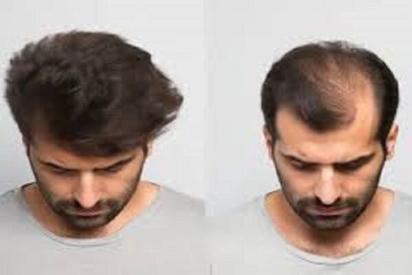 Hair Transplant in Riyadh